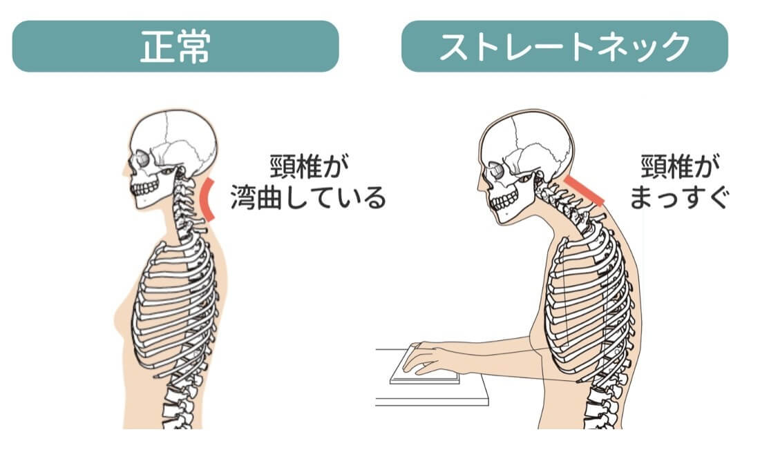 Illustration of normal neck and straight neck skeleton